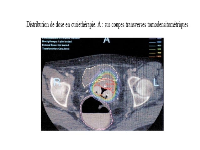 cancerologue en martinique