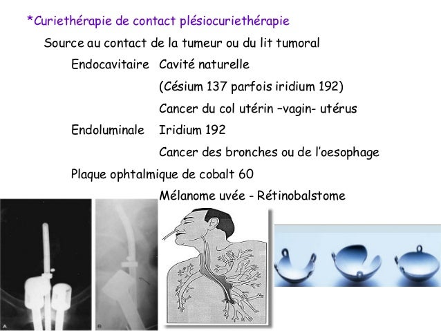 Curiethérapie Haut Débit