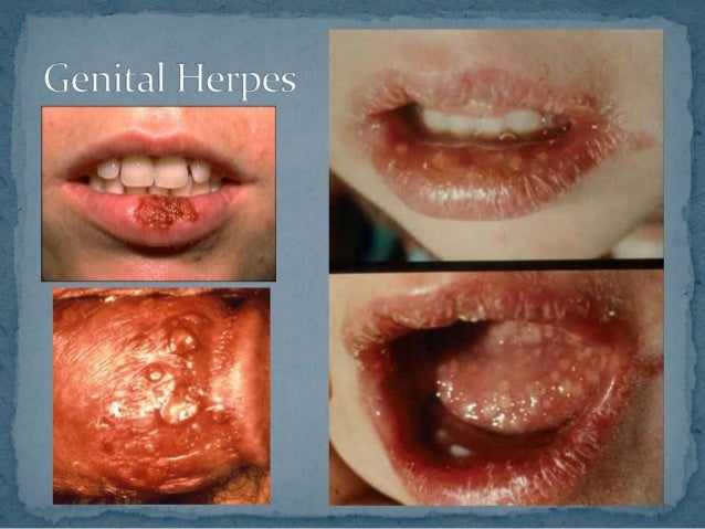 What diseases can you get from oral sex picture 59