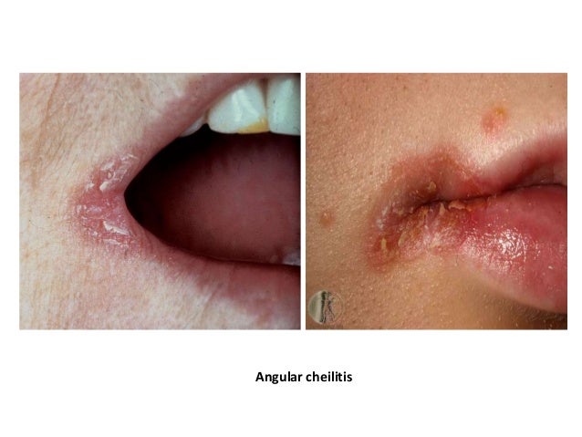 SEARCH AND BUY THIS PRODUCT Cheilitis