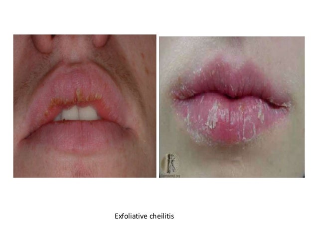 exfoliative cheilitis treatment