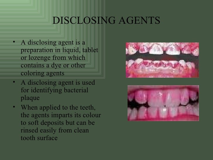 Chemical Plaque Control