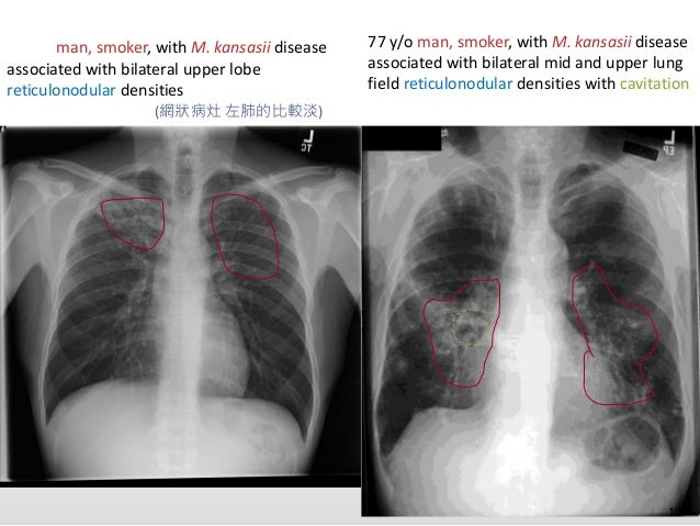 Chest imaging of ntm pulmonary disease2