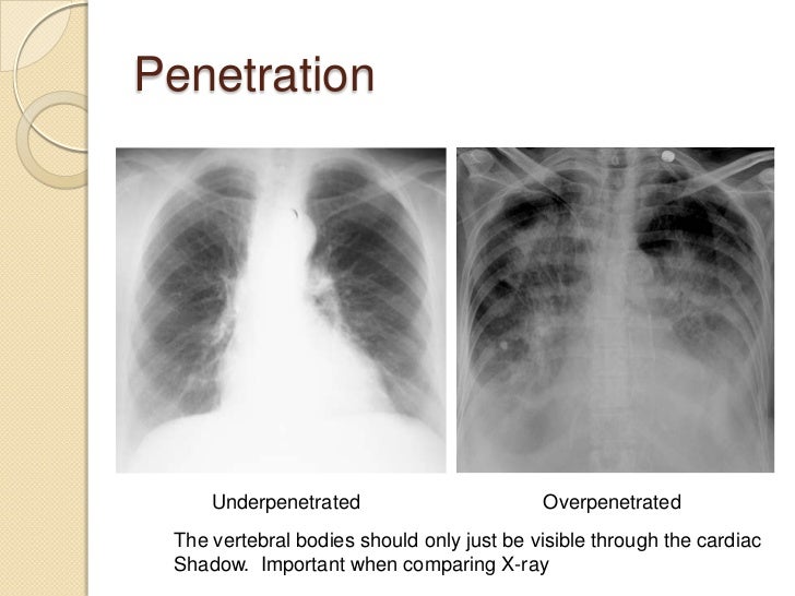Chest radiography introduction