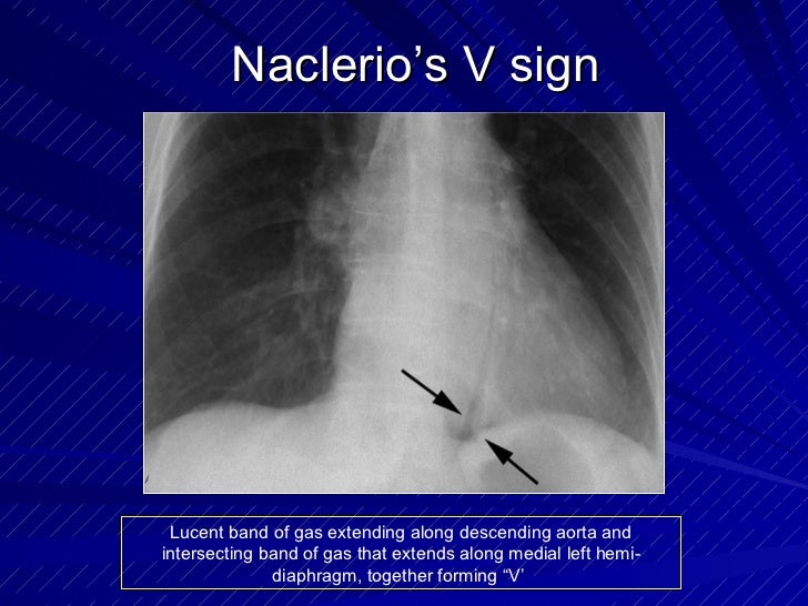 Naclerio's v sign Medical sign, Radiology, Signs