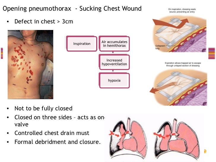 Chest trauma