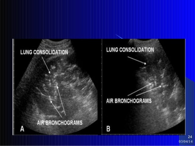 Pleural Mesothelioma Detection