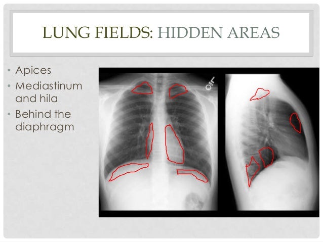 Normal Chest X-ray diagram of sternum area 