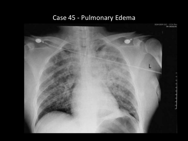 what form of most cancers is mesothelioma