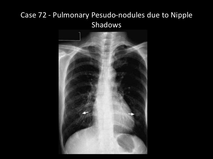 numerous styles of asbestos