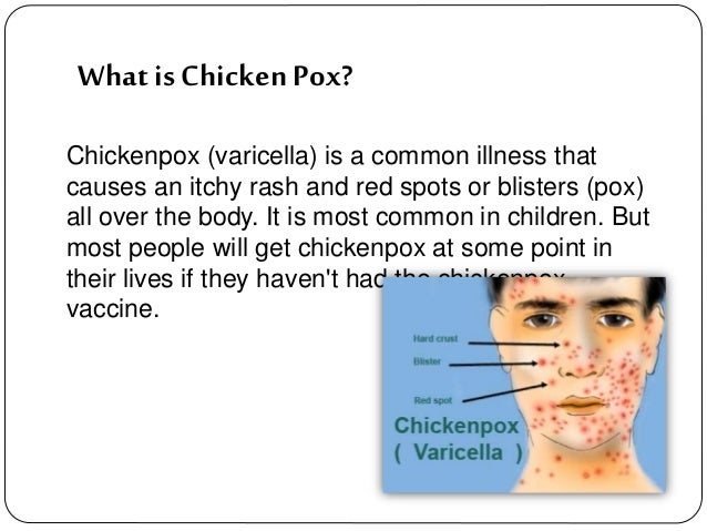 Chicken pox