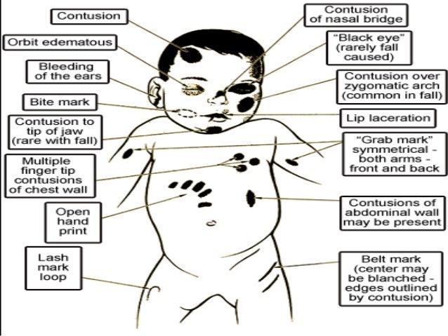 child abuse case studies child abuse case studies