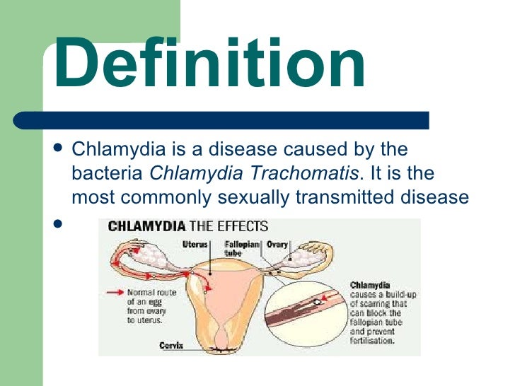 Chlamydia