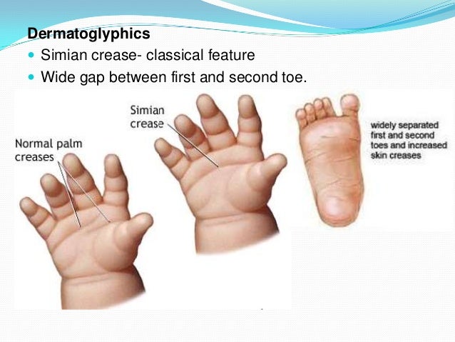 Wartenberg's Syndrome - Hand - Orthobullets.com