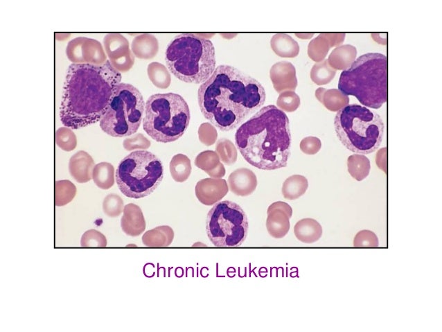 Acute Leukemia Chronic Acute Leukemia