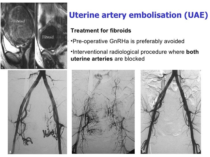 Affects Of Synthroid On Uterine Fibroids