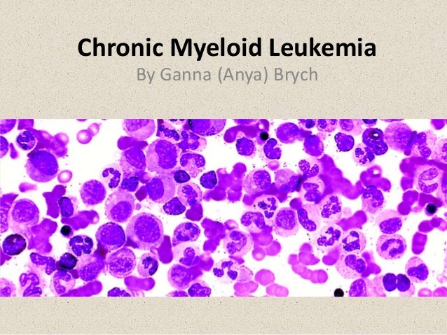 chronic myelogenous leukemia cml chronic myelogenous leukemia cml
