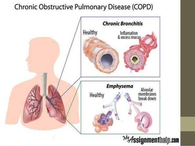 1 chronic obstructive pulmonary disease and 1 chronic obstructive pulmonary disease and