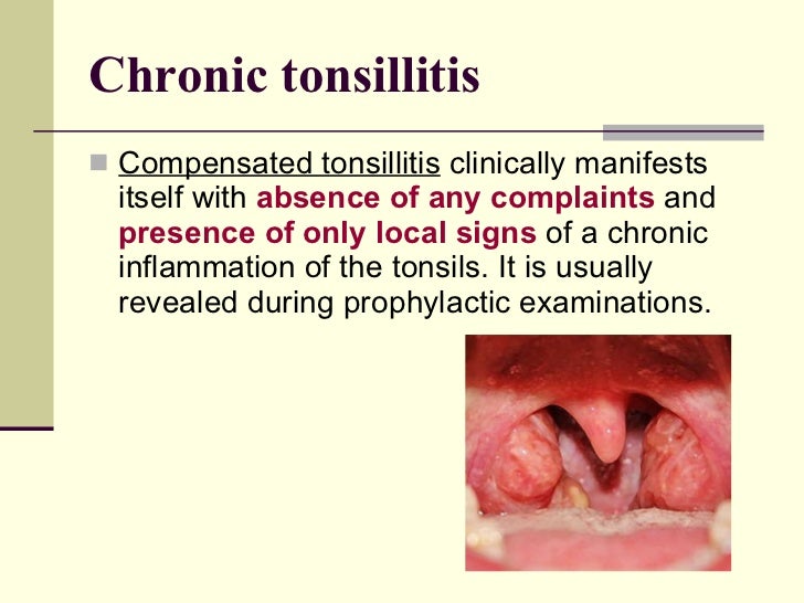 What Causes Tonsillitis In Adults What Causes Tonsillitis In Adults