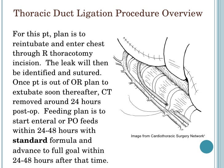 Chylothorax Case Study