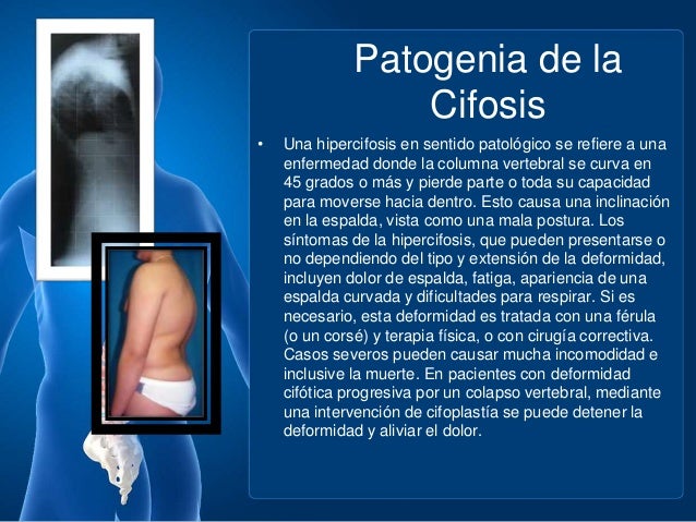 El mejor medio para el tratamiento sheynoy las hernias
