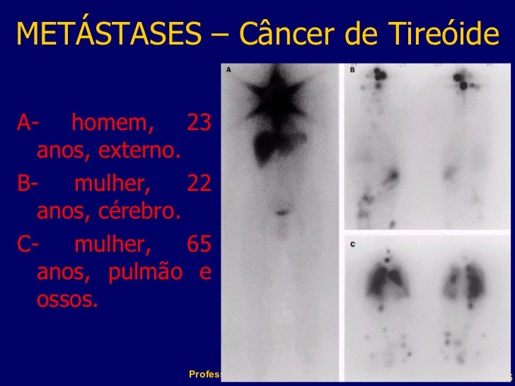 Metastase Tratamento