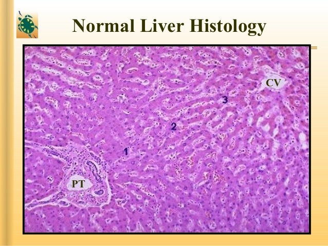 portal hypertension