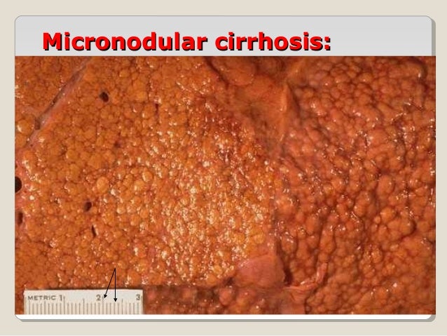 Cirrhosis of liver.2003 all