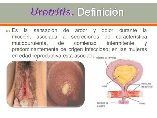 Cistitis Cistitis