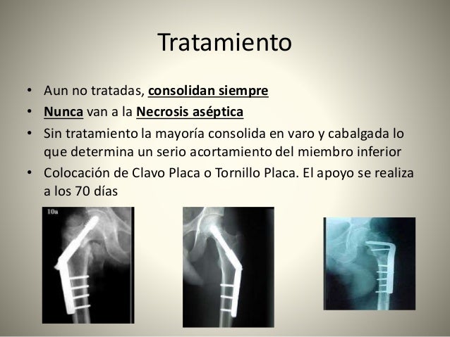 El método de la desaparición de los asteriscos vasculares