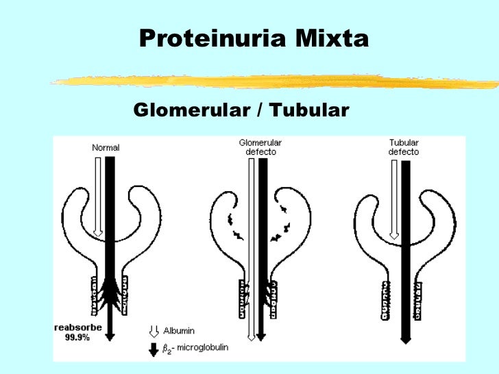 Proteinuria y sus causas