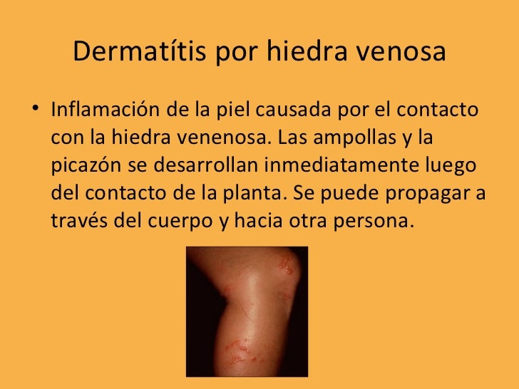 Ranki sobre la cabeza la psoriasis