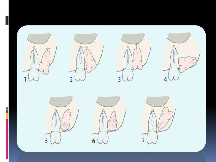 Maxillary Sinus enamel