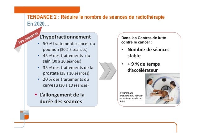 Cancer Du Cerveau Radiothérapie