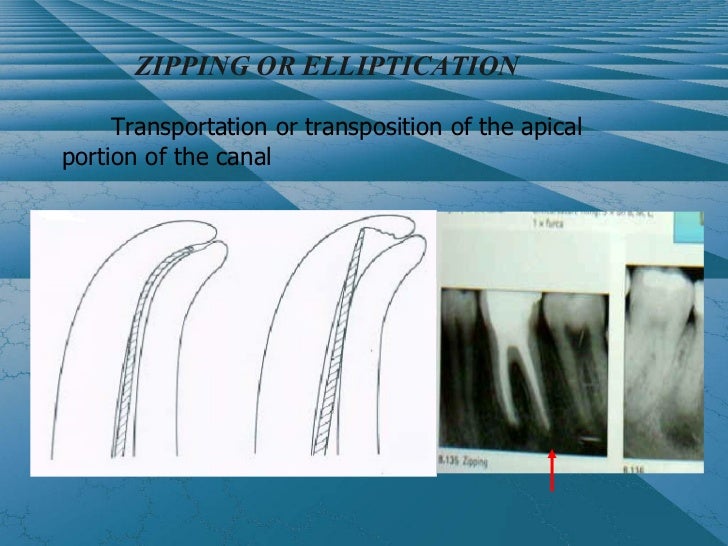 Cleaning and shaping the root canal system
