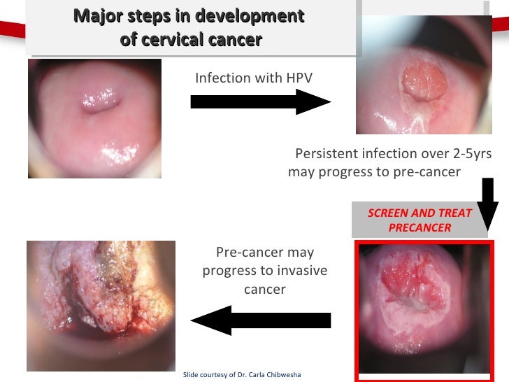 cervical most cancers signs and symptoms most cancers of the cervix while pregnant