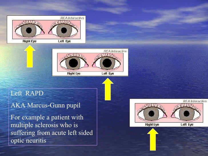 unequal pupil size but constrict equally unequal pupil size but constrict equally
