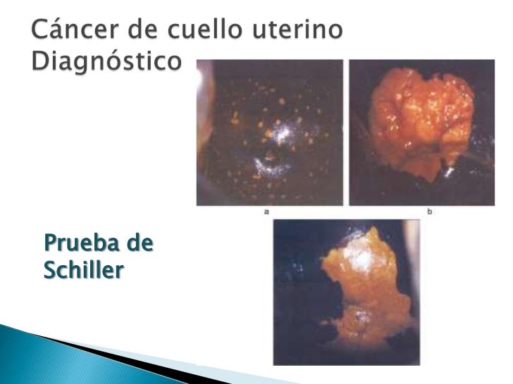 remedy of cancer