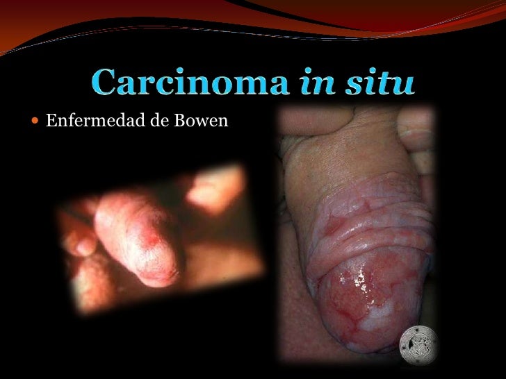 La carga al pene para el aumento