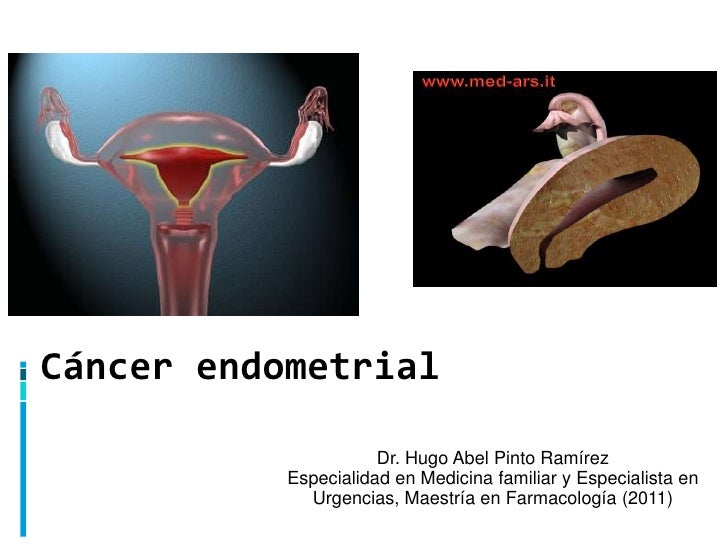 Cervical cancer reasons bloating cervical cancer stroll