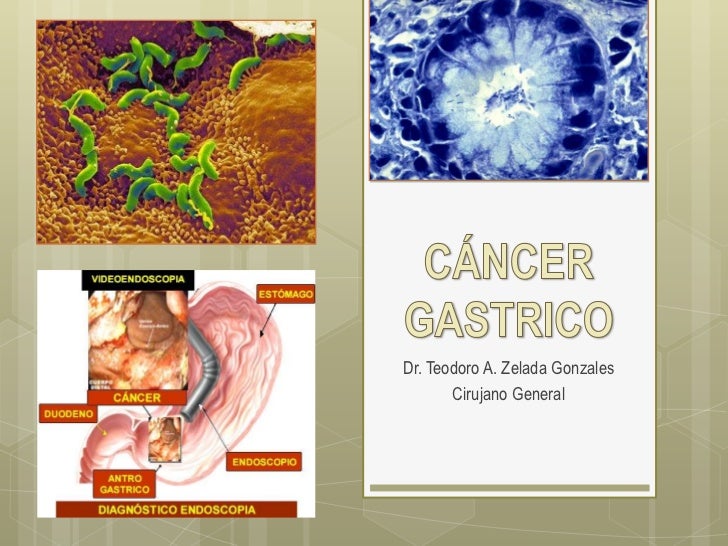 CANCER GASTRICO GASTRECTOMIA cancer gastrico gastrectomia: