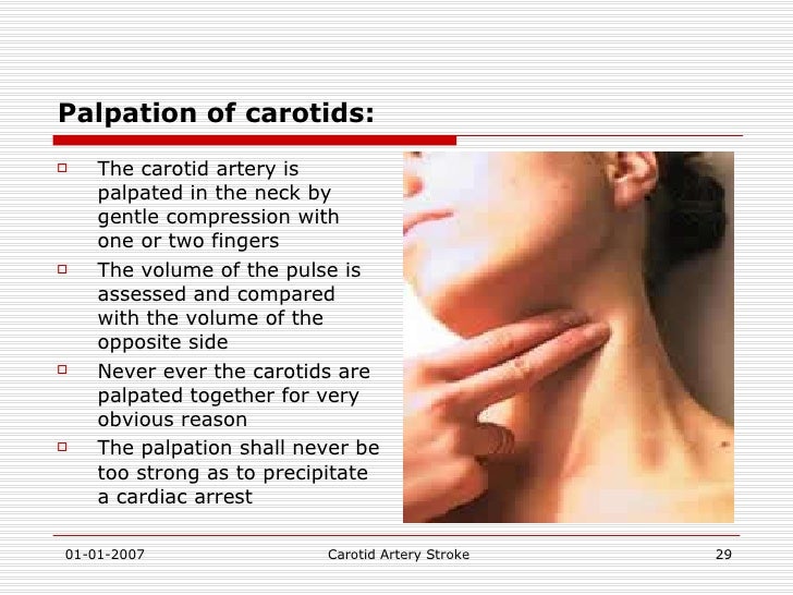 Carotid Artery Stroke