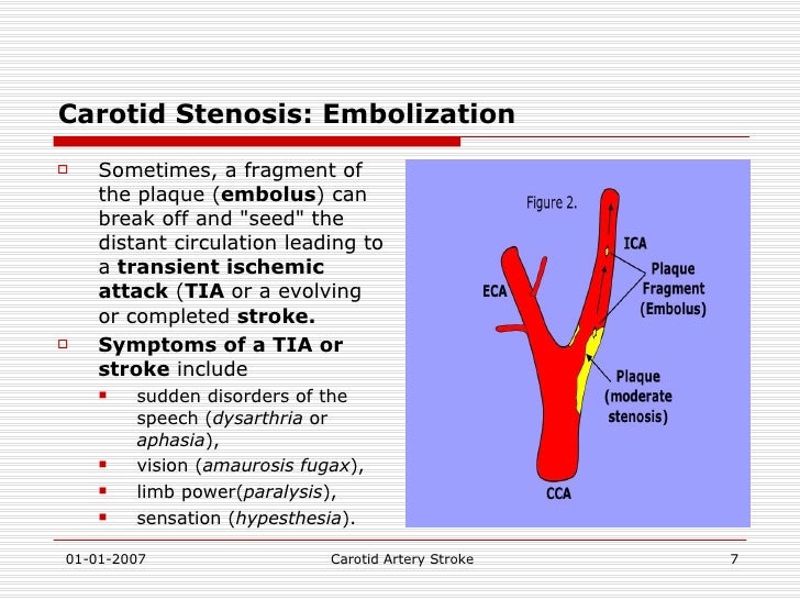 Carotid Artery Stroke