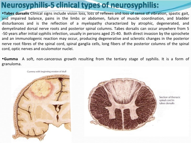 Cns infections Lecture