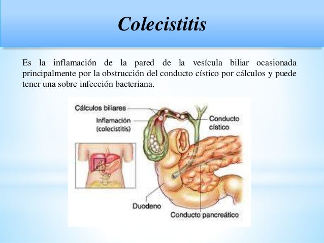 Colecistitis su fisiopatologia, causas y cuidados de Colecistitis su fisiopatologia, causas y cuidados de