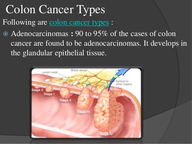 treatment of cancer Cervical cancer is a cancer arising from the cervix it is due to the abnormal growth of cells that have the ability to invade or spread to other parts of the body. treatment of cancer Cervical cancer is a cancer arising from the cervix it is due to the abnormal growth of cells that have the ability to invade or spread to other parts of the body.