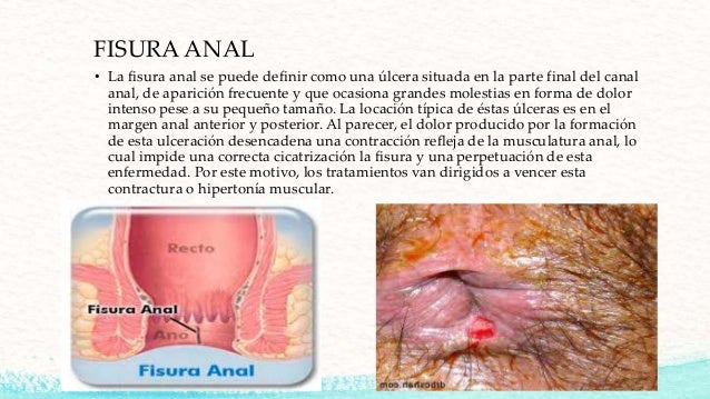 Tratamiento para ulcera anal Miss world transsexual