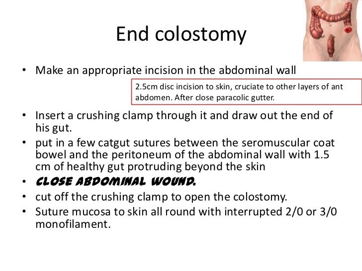 Colostomy