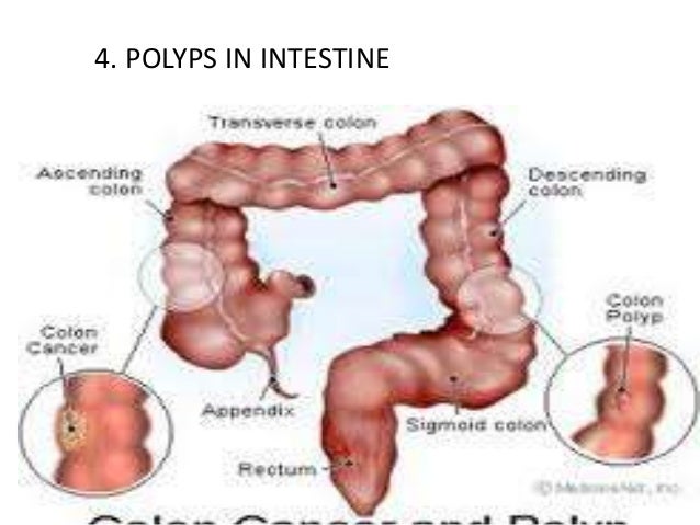 Colostomy