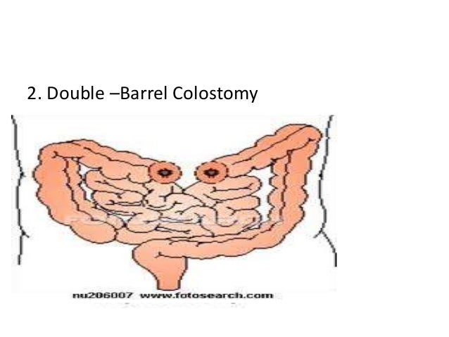 Colostomy colostomy